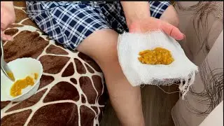 За 20 минут вся Боль Уйдёт👍Колени больше не болят!!!Рецепт