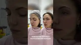 Улучшаем качество кожи и избавляемся от морщин: векторный лифтинг Radiesse
