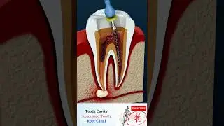 ROOT CANAL TREATMENT- Abscess Tooth - Cavities - endodontics - RCT
