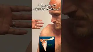 Severe AC Joint Dislocation! Explained By Orthopedic Surgeon #shorts #shoulder #surgeon