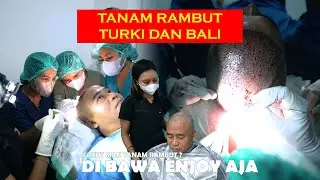 TANAM RAMBUT TURKI HADIR DI BALI ?!? | HAIRTRANSPLANT 42 jt all in full graft