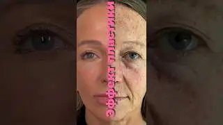Пилинг  с эффектом пластики , феноловый пилинг 