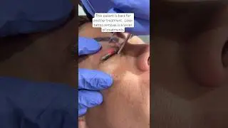 Laser tattoo removal for eyeliner tattoo #dermatologist #shorts