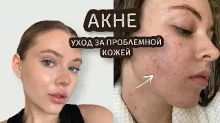 АКНЕ | уход за проблемной кожей