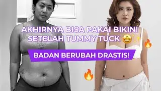 BYE-BYE PERUT GELAMBIR! Setelah tummy tuck langsung bisa pakai Bikini! 👙