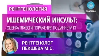 Врач-рентгенолог Пекшева М.С.: Ишемический инсульт: оценка тяжести поражения по данным КТ