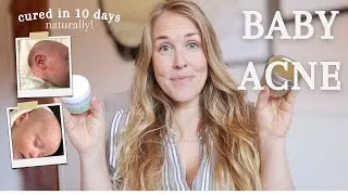 Get Rid of Baby Acne Naturally  |  Newborn Acne Cure