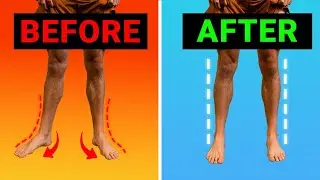 How To Fix Your Turned Out Foot (duck feet) - VERY FAST Results!