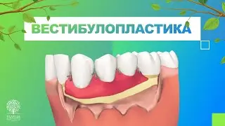 👉 Вестибулопластика в стоматологии