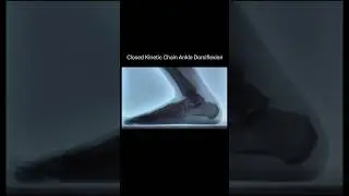 Closed Kinetic Chain Ankle Dorsiflexion via Dynamic X-Ray 