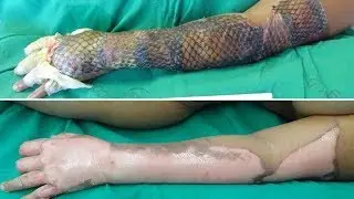 Brazilian doctors are using fish skin to treat burn victims – here's why.