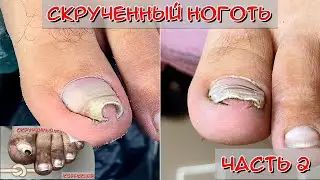 Скрученные ногти - Капитан Аэро (Часть 2) / Коррекционная система титановая нить