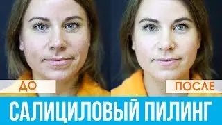 ЭФФЕКТИВНОЕ лечение АКНЕ салициловым пилингом / РЕАЛЬНЫЙ РЕЗУЛЬТАТ