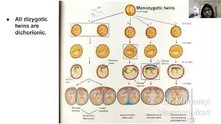 Multifetal gestation Part-1- Double the trouble or twice the joy? -By Dr. Mrinmayi Dharmadhikari