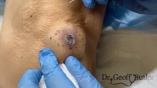 Is this a pyogenic granuloma?