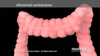 Irritable Bowel Syndrome (IBS)