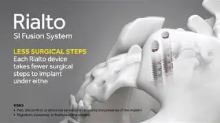 Medtronic: Rialto SI Fusion