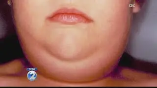 21 reports of mumps complications in Hawaii