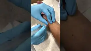 Ganglion Cyst Drainage at Plum Health DPC in Detroit