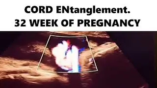 CORD ENtanglement. 32 WEEK OF PREGNANCY #ultrasound #pregnancyscan #baby #pregnancytest