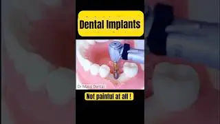 Dental Implants is not Painful at all !