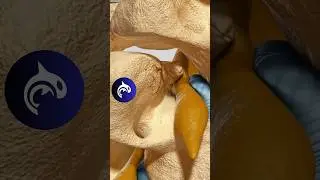 Foraminal Stenosis - 3D Animation 