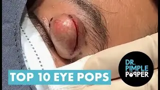 Most Cringeworthy Eye Pops! The Best Eye Pops! Picked By Dr Pimple Popper
