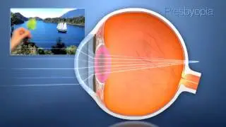 Presbyopia