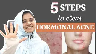 5 Steps to Heal Hormonal Acne | Cure Hormonal Acne | PCOS Acne