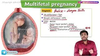 Multifetal Gestation ( Part - 2 ) : Obstetrics and gynaecology lecture