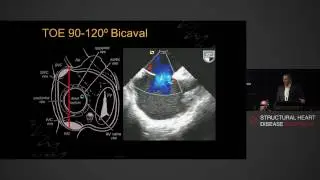 Atrial Septum - Anatomy, Echocardiography & Interventions - A/Prof Gregory Scalia