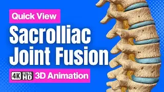 Sacroilliac (SI) Joint Fusion // See How It Works // 3D animation