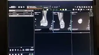 MRI ANKLE PLANNING PARAMETERS LOCOLZER