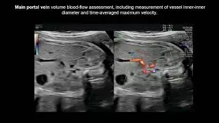 Changes in afferent venous perfusion of the liver in low-risk SGA fetuses