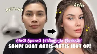 Operasi Hidung Doang Tapi Kok Berubah Banget?!🤩😱