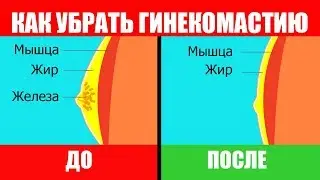 Как Вылечить Гинекомастию в домашних условиях