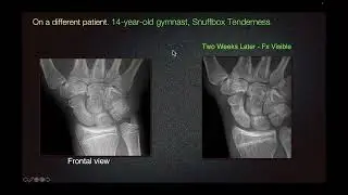 Sports Medicine Case 16: Collegiate Diver Makes a Splash with Acute Wrist Pain