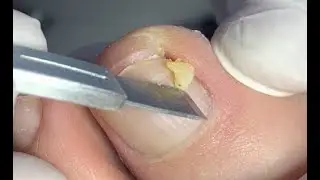 Very thick nail digging