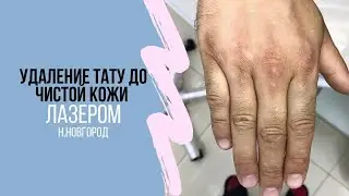 Удаление тату лазером до чистой кожи. ДО и ПОСЛЕ. Н.Новгород