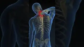 PERSISTENT RHOMBOID PAIN.  BEST Exercises & Stretches