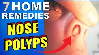 7 Natural Treatments & Home Remedies For Nasal Polyps