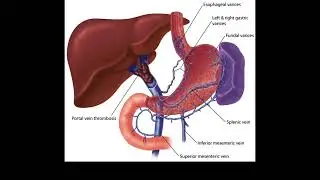 Portal vein thrombosis