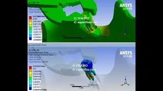 Simulation of the Movements Occurring During Molar Extraction Procedure - ANSYS WB Explicit Dynamics