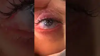 Así se ve un ojo luego de un trasplante de córnea ￼🤔👁️ 