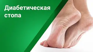 Синдром диабетической стопы