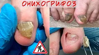 Онихогрифоз / Криво растет ноготь на ноге