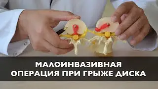 Малоинвазивная операция при грыже диска | Эндоскопическое удаление грыжи диска