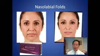 What's the Best Filler for Smile Lines - Nasolabial Folds Consultation - Dr. Anthony Youn