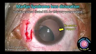 CataractCoach™ 2006: Marfan Syndrome lens dislocation