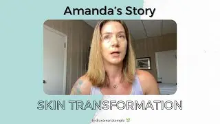 Skin Transformation Testimonial - Amanda's Story